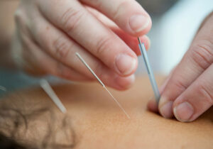 Acupuncture vs. Dry Needling: Why Ancient Wisdom Offers a Fuller Path to Healing